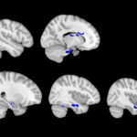 x-rays showing brain damage